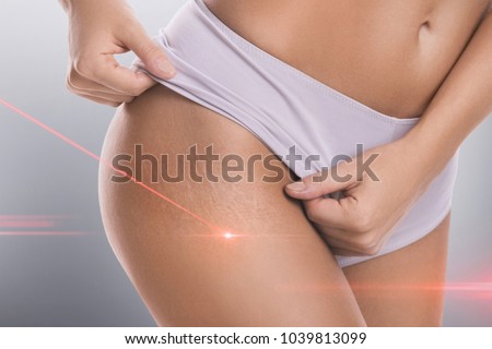 Close-up of female hips with a stretch marks during laser removal session treatment