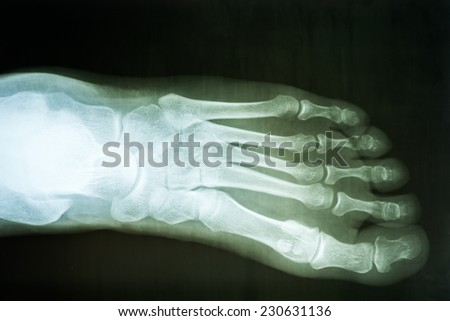 Human Foot X-Ray On Black Background