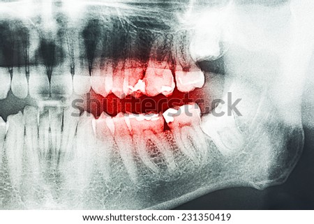Decayed Tooth Pain On X-Ray