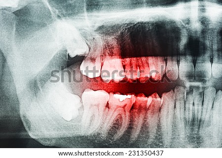 Decayed Tooth Pain On X-Ray