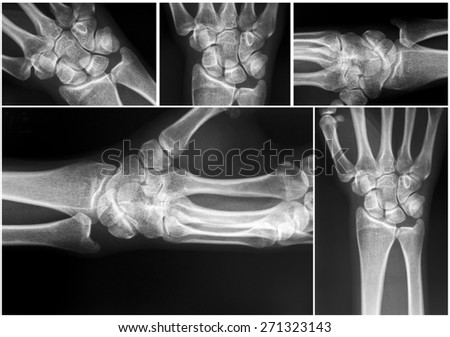 X-Ray Of Carpal And Metacarpal Bones In The Human Hand