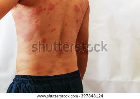 Around Back view of man with dermatitis problem of rash ,Allergy rash and Health problem.