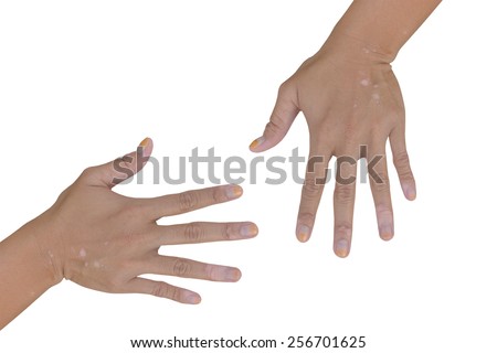 Vitiligo is a medical condition causing depigmentation of patches of skin