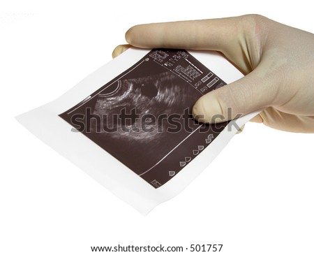 ovary sonogram