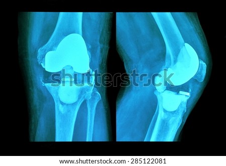 xray knee prosthesis