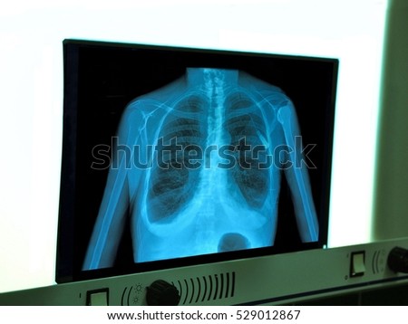 X-ray of chest heart stimulator