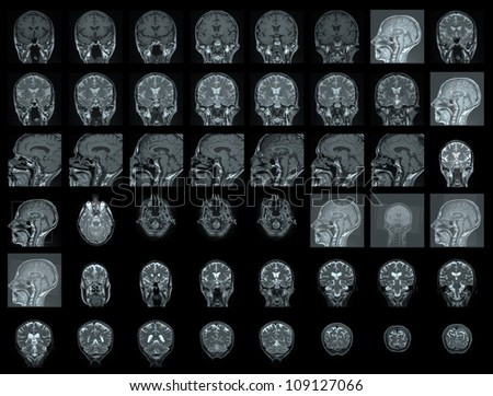 MRI of human brain