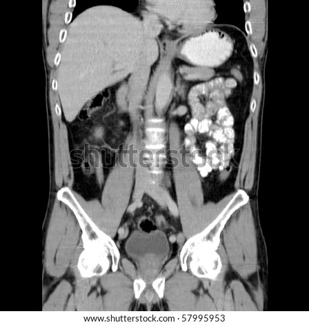 Computed tomography of abdomen