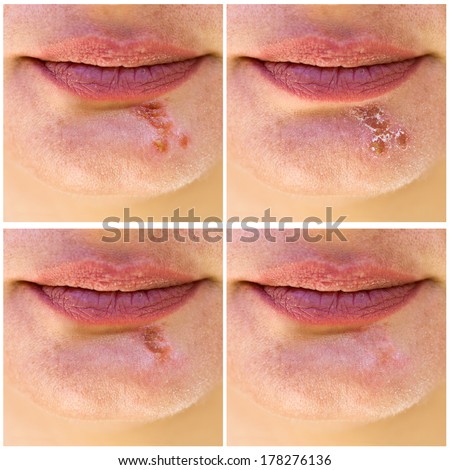 Four phases of herpes virus at female face.Split screen