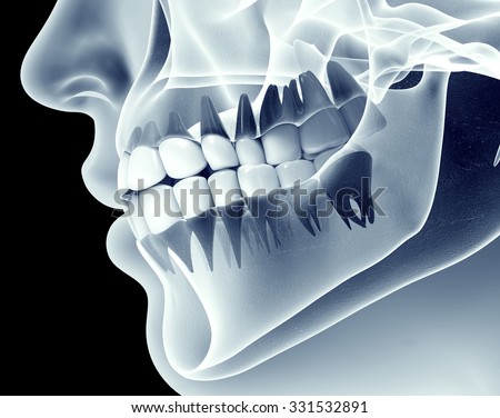 x-ray image of a jaw with teeth.