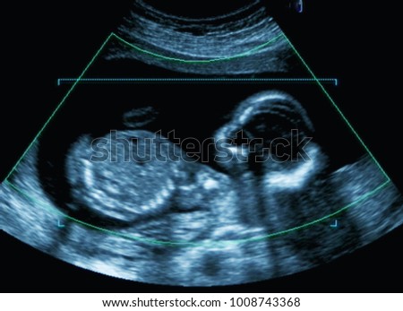 Medical image of mother\'s womb ultrasound during pregnancy.
