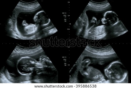 Medical images collage of ultrasound during woman pregnancy showing fetus in third month.
