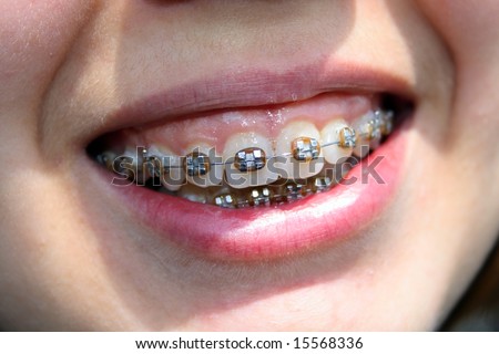 young womans smile with braces