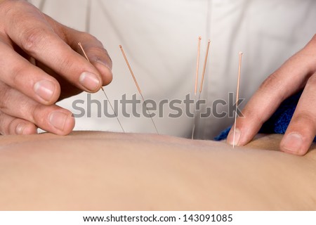 Adult Male Physiotherapist Is Doing Acupuncture On The Back Of A Female Patient. Patient Is Lying Down On A Bed And Is Covered With Royal Blue Towels.