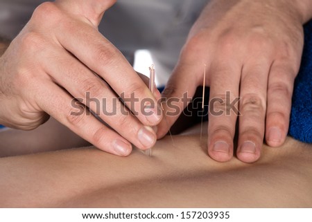 Adult male physiotherapist is doing acupuncture on the back of a female patient. Patient is lying down on a bed and is covered with royal blue towels.