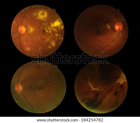 View set inside human eye disorders - showing retina, optic nerve and macula .
