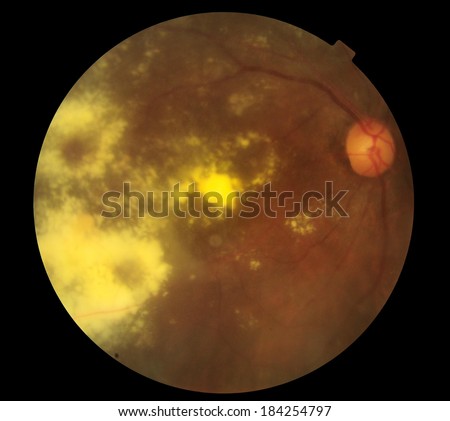 View inside human eye disorders - showing retina, optic nerve and macula .