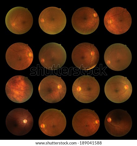 View inside human eye disorders - showing retina, optic nerve and macula .