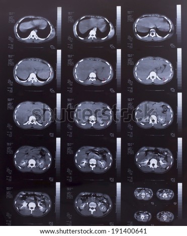 Closeup of a CT scan with chest and abdomen,