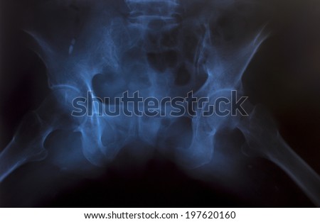 X-Ray Image Of Human Chest for a medical diagnosis