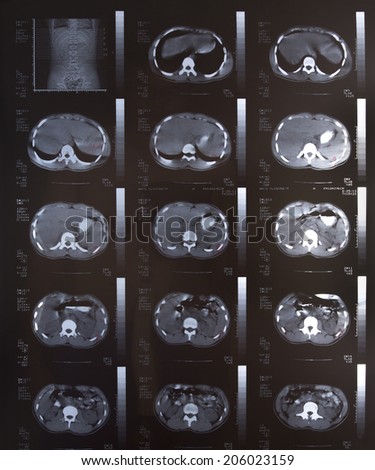Closeup of a CT scan with chest and abdomen