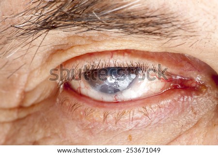 close up of the senile cataract during eye examination