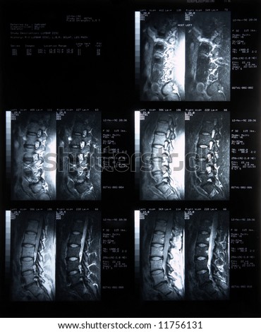 MRI of lumbar disc, all information is anonymous