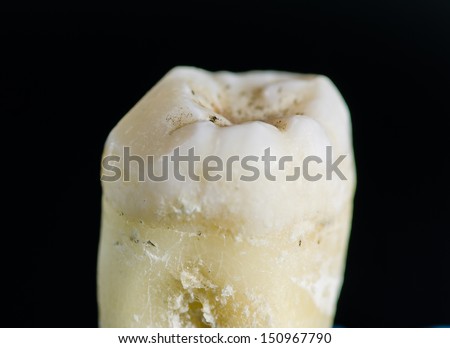 Crown of 3rd  molar - extracted tooth