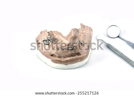 Dental cast with metal framework for partial denture