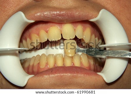 Dental patient about to undergo tooth whitening procedure
