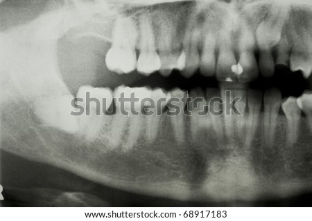 Panoral dental X Ray showing impacted wisdom tooth