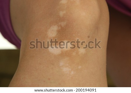 Knee with vitiligo skin condition