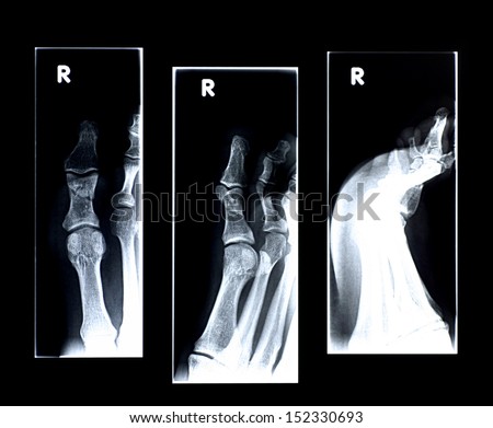 X-ray: Broken big toe