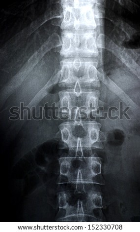 X-ray: lumbar spine front view