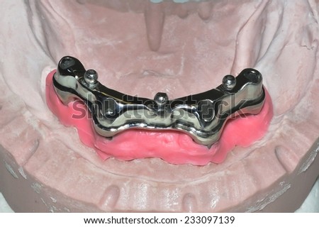 Detail of the bar of a dental implant for removable prosthesis with hooks pressure of the prosthesis.