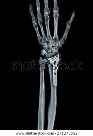 Distal radial fracture, internal fixation, x ray in cast.