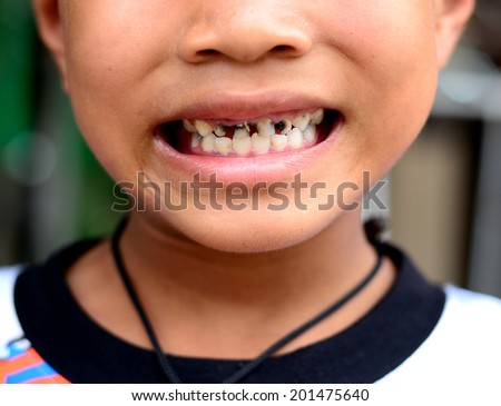 Boy try to smile with decay teeth