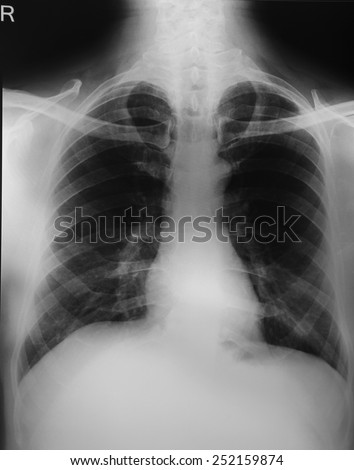 Black and white Digital X-ray image of chest showing lungs, ribs, heart, vertebrae, shoulder bone and collar bone.