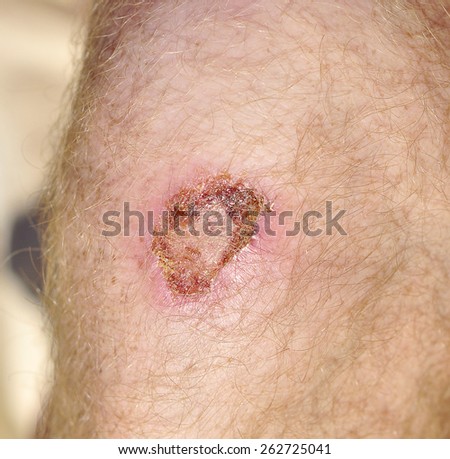 wound with pus in the knee men