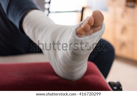 Close up of a young man\'s fiberglass / Plaster leg cast and toes after a running injury