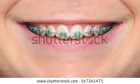 Close up smile of an teenage girl wearing orthodontic braces.