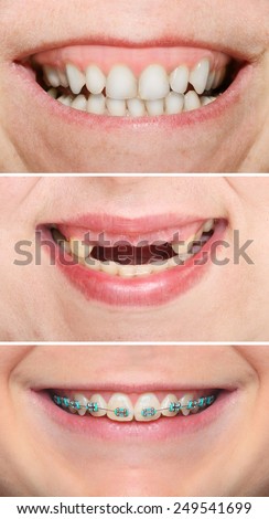 Set of different smiles with teeth. Great for dentistry advertising.