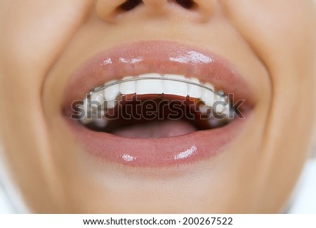 Smiling girl with retainer on teeth, close-up