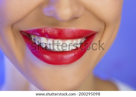 Beautiful smiling girl with retainer for teeth, and with red lipstick (on a blue background)