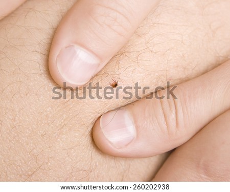 correct removing a tick from skin of patient