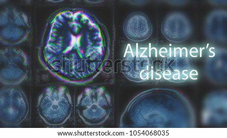 Alzheimer\'s disease or Parkinson concept. Blurred MRI scan of brain with glitch effect, toned