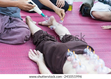 Chiangmai, Thailand - November 8, 2014: leg and back skin cupping vacuum, the chinese alternative medicine for detoxifying