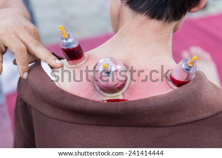 Chiangmai, Thailand - November 8, 2014: back skin cupping vacuum and Phlebotomy, the chinese alternative medicine for detoxifying