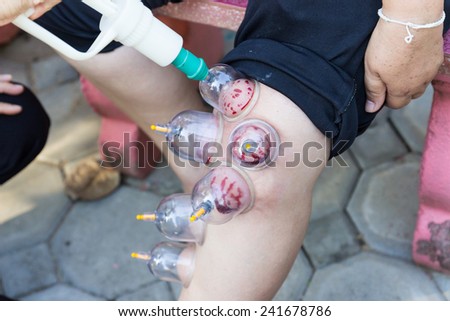 Chiangmai, Thailand - November 9, 2014: leg skin cupping vacuum and Phlebotomy, the chinese alternative medicine for detoxifying