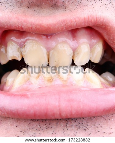Diseased teeth of the patient. Tartar and tooth decay
